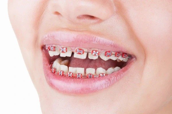 Braces Create Small Gap Between Front Teeth- Is It Normal?