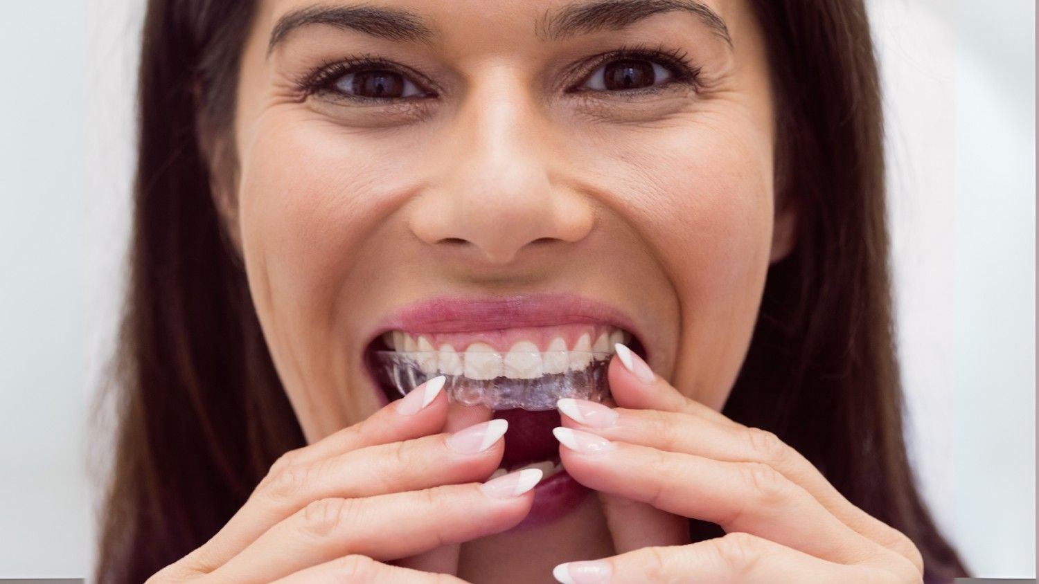 Can Invisalign Fix an Overbite? What You Need to Know