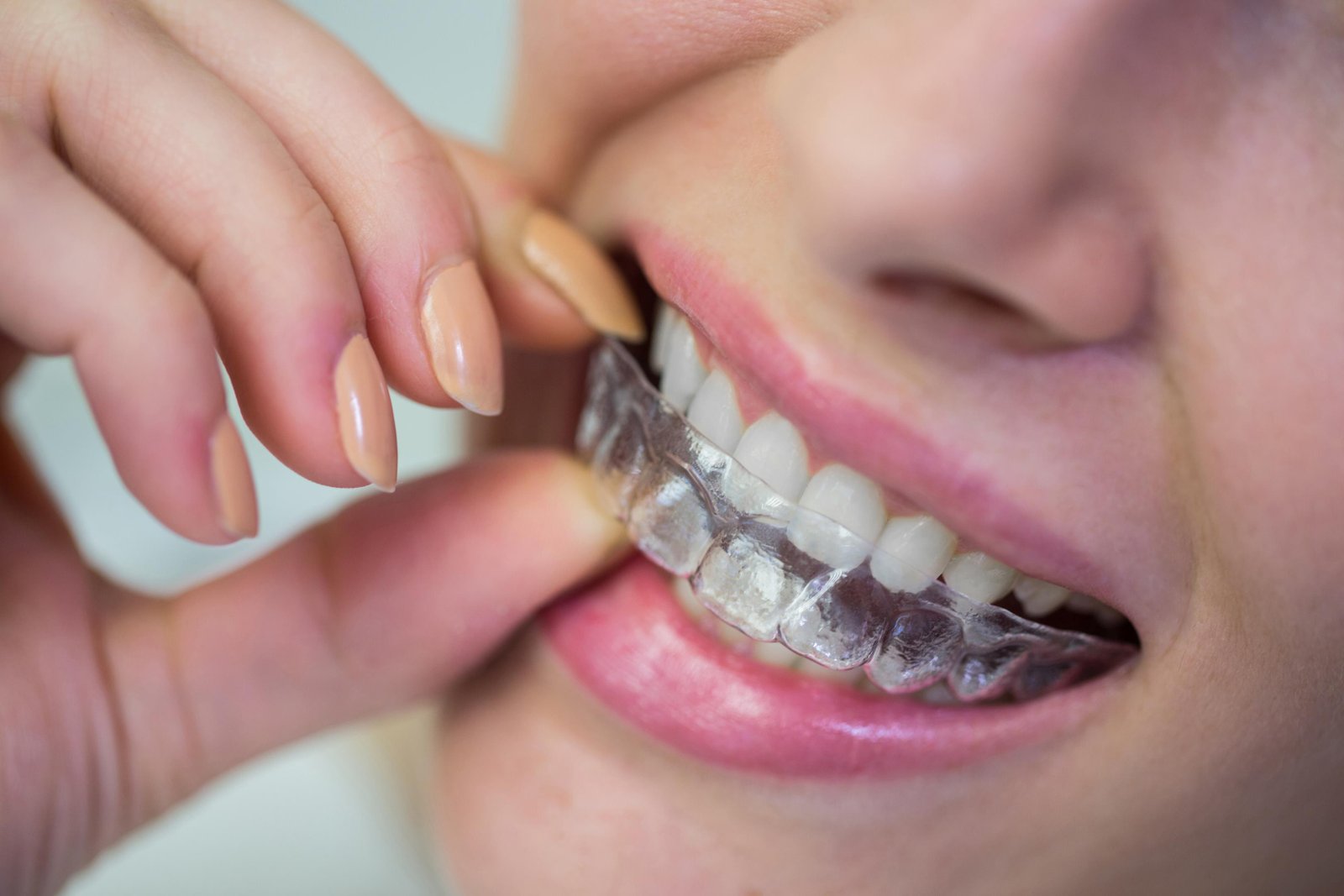 Can Invisalign Fix an Underbite?