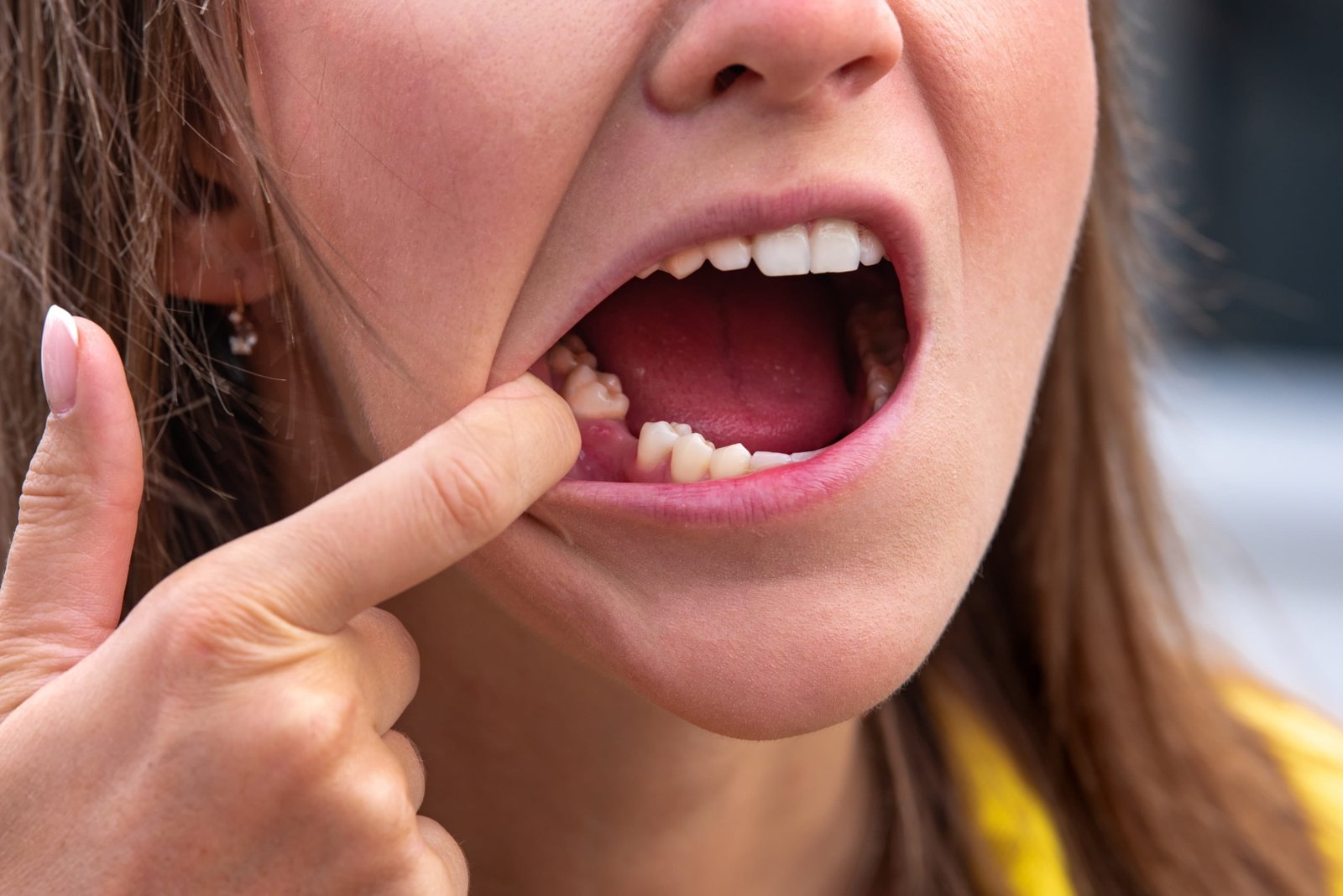 Can You Get Braces with Missing Teeth? Here’s What Orthodontists Say