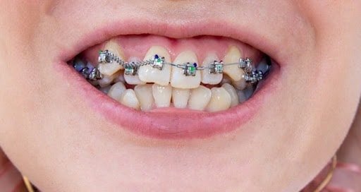 How Braces Can Correct Crooked Teeth: A Complete Guide
