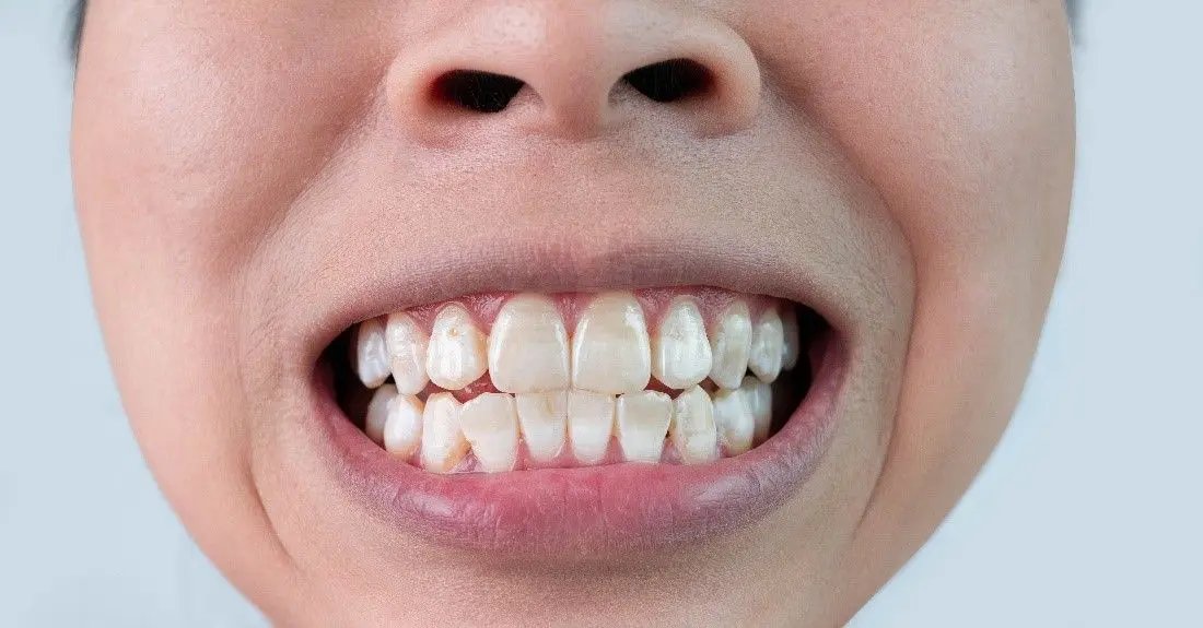 How Braces Can Lead to White Marks and What You Can Do About It