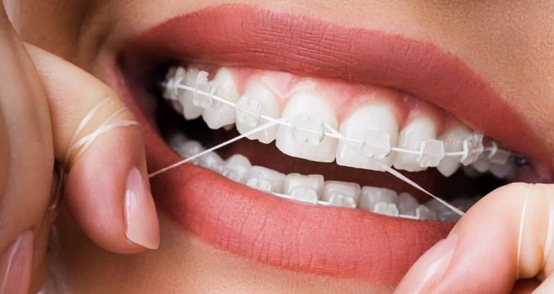 The Best Techniques to Floss Teeth with Braces Effectively