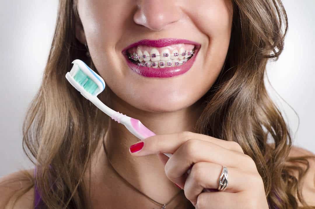 How Braces Can Lead to White Marks and What You Can Do About It