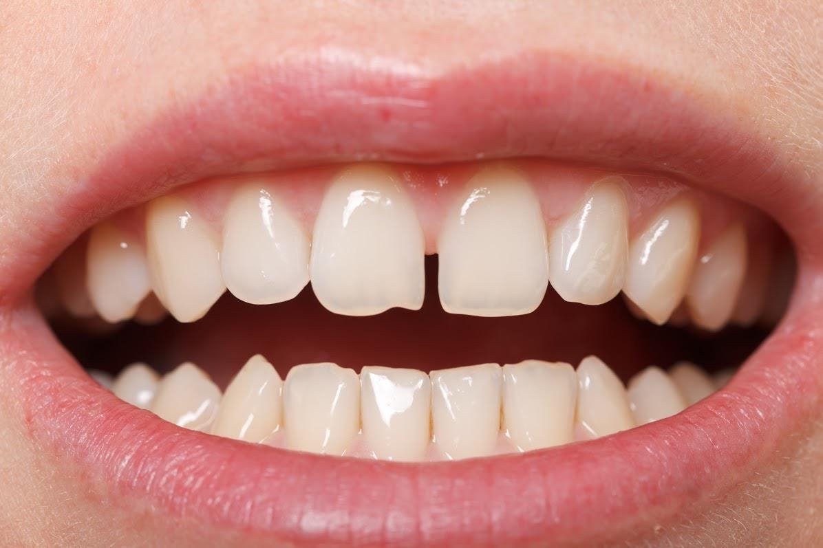 How to Fix a Gap Between Teeth: Treatment Options Compared