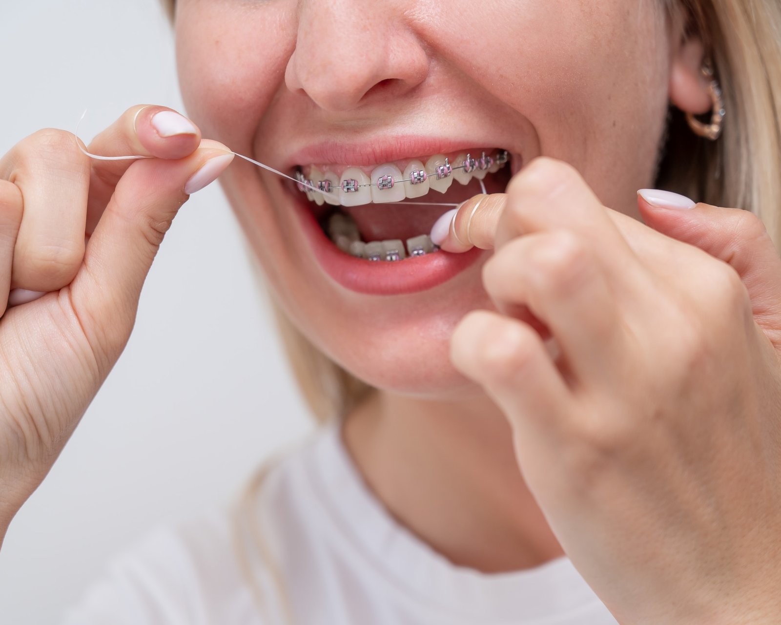 The Best Techniques to Floss Teeth with Braces Effectively