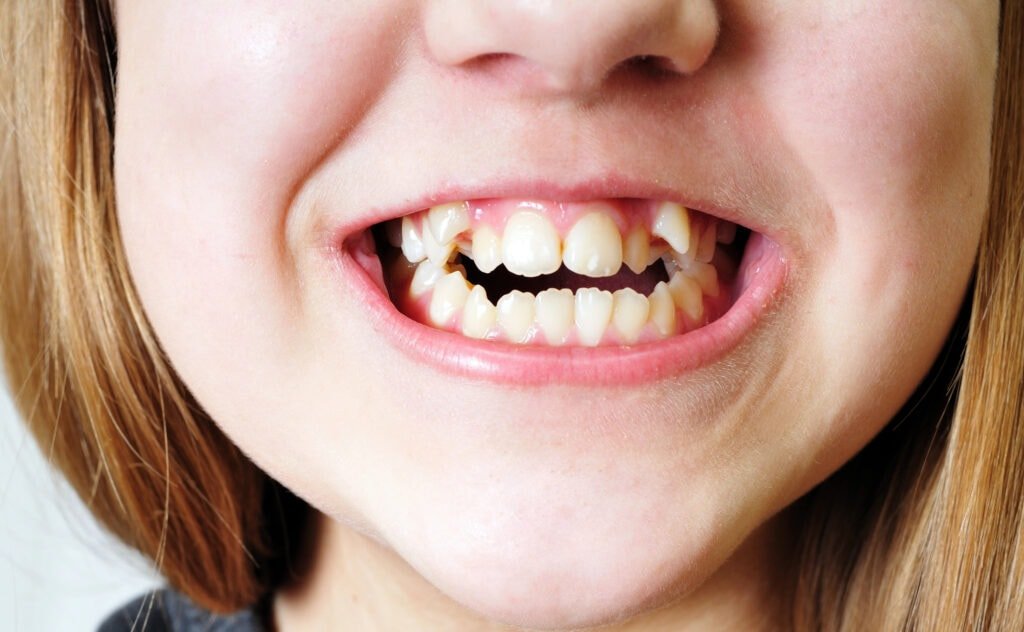 Invisalign for Crowded Teeth: Does It Work and How Long Does It Take?