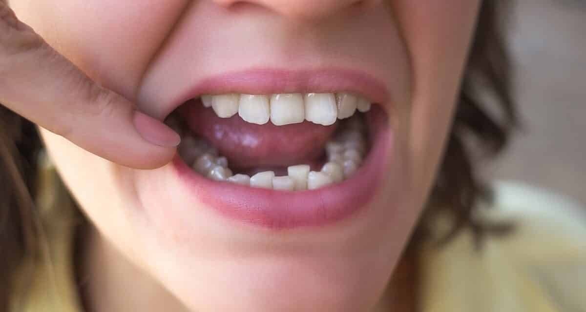 What Causes Crowded Teeth and How Dentists Fix Them? - Dr. Dante Gonzales Orthodontics