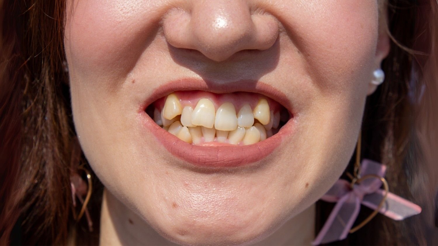 What Is a Deep Bite? Key Facts and Expert Tips on Managing It