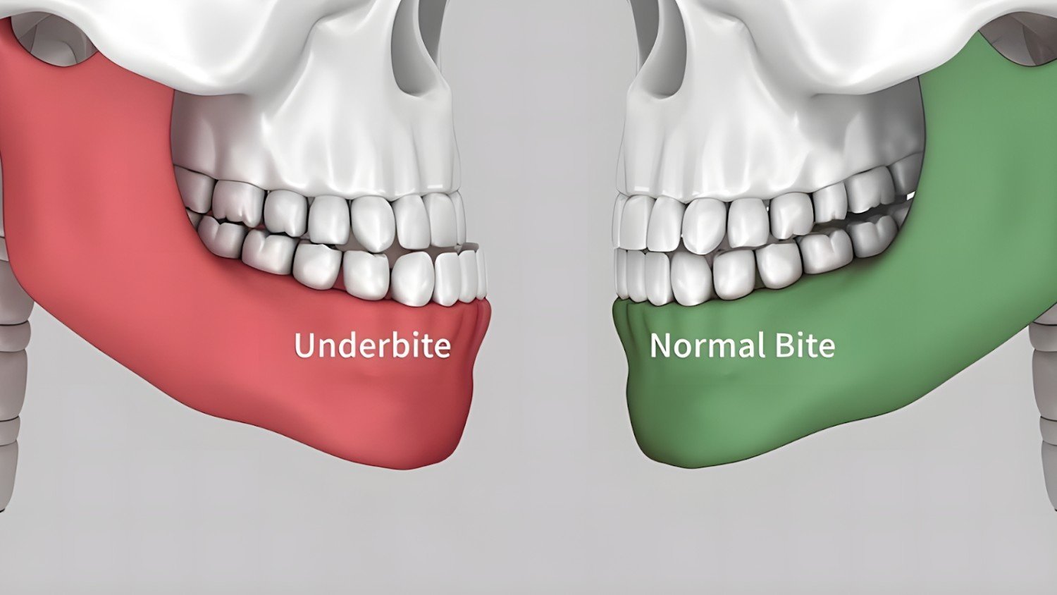 Can Invisalign Fix an Underbite? What Orthodontists Want You to Know