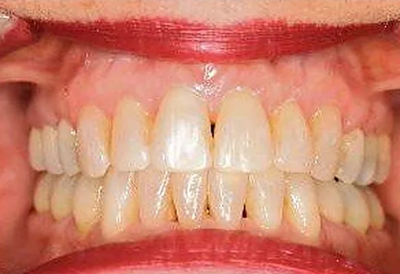 Patient’s teeth after orthodontic treatment at Dante Gonzales Orthodontics