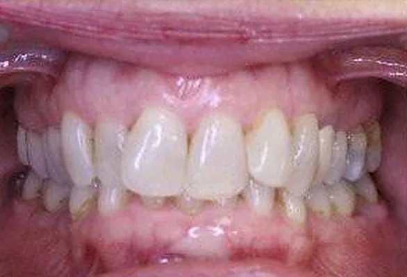 Patient’s teeth before orthodontic treatment at Dante Gonzales Orthodontics