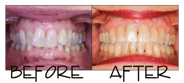 Patient 2 before and after orthodontic treatment at Dante Gonzales Orthodontics