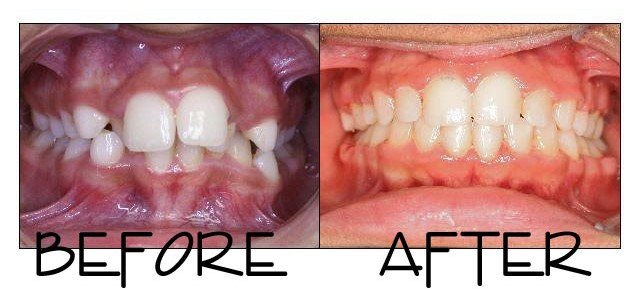 Patient 1 before and after orthodontic treatment at Dante Gonzales Orthodontics