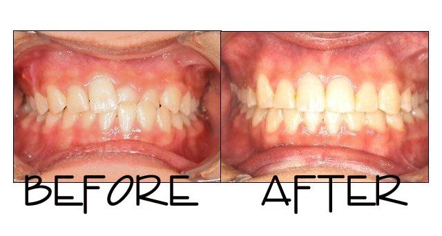 Patient 5 before and after orthodontic treatment at Dante Gonzales Orthodontics