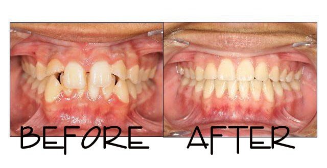 Patient 6 before and after orthodontic treatment at Dante Gonzales Orthodontics