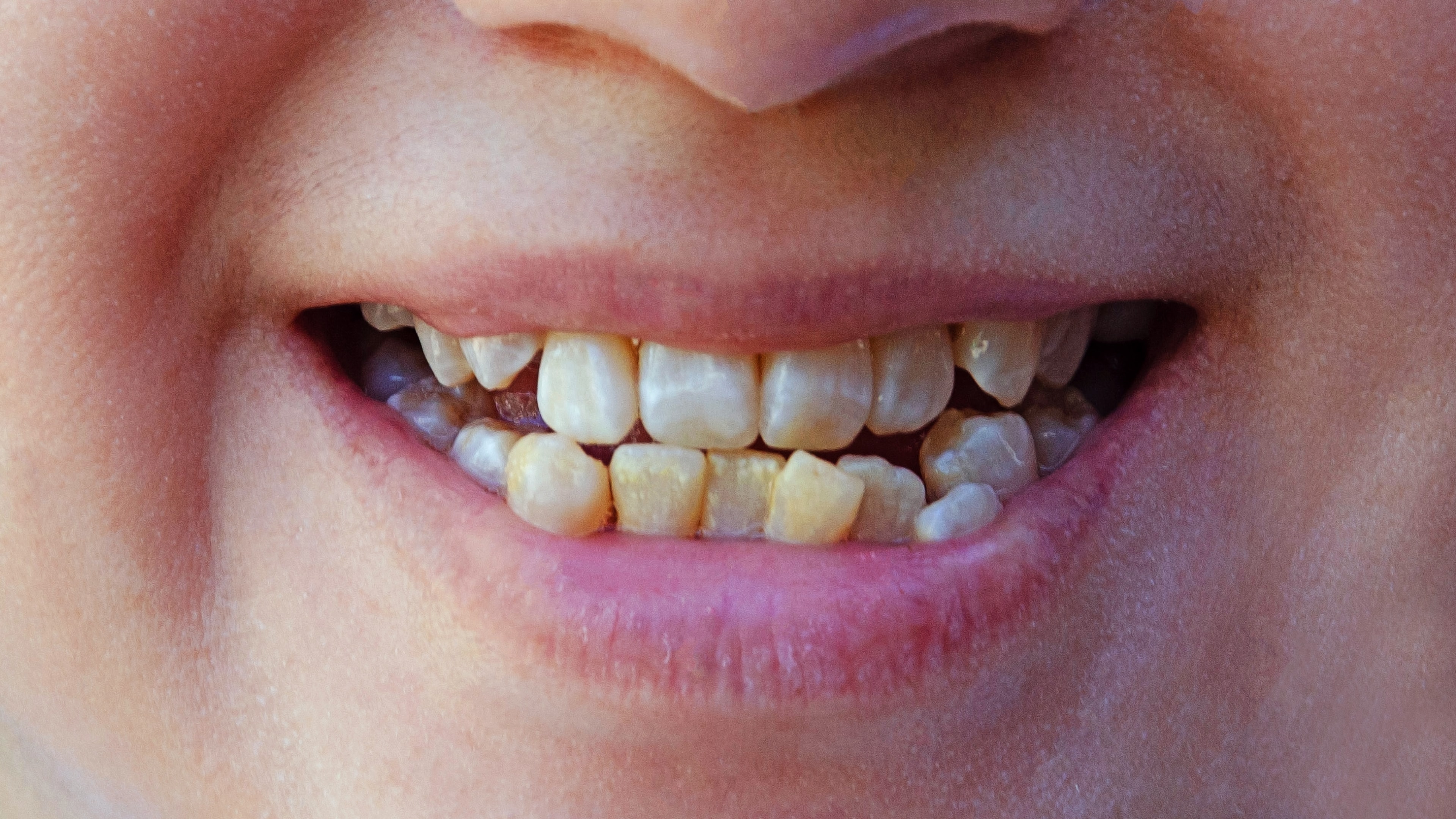 Are braces faster than Invisalign