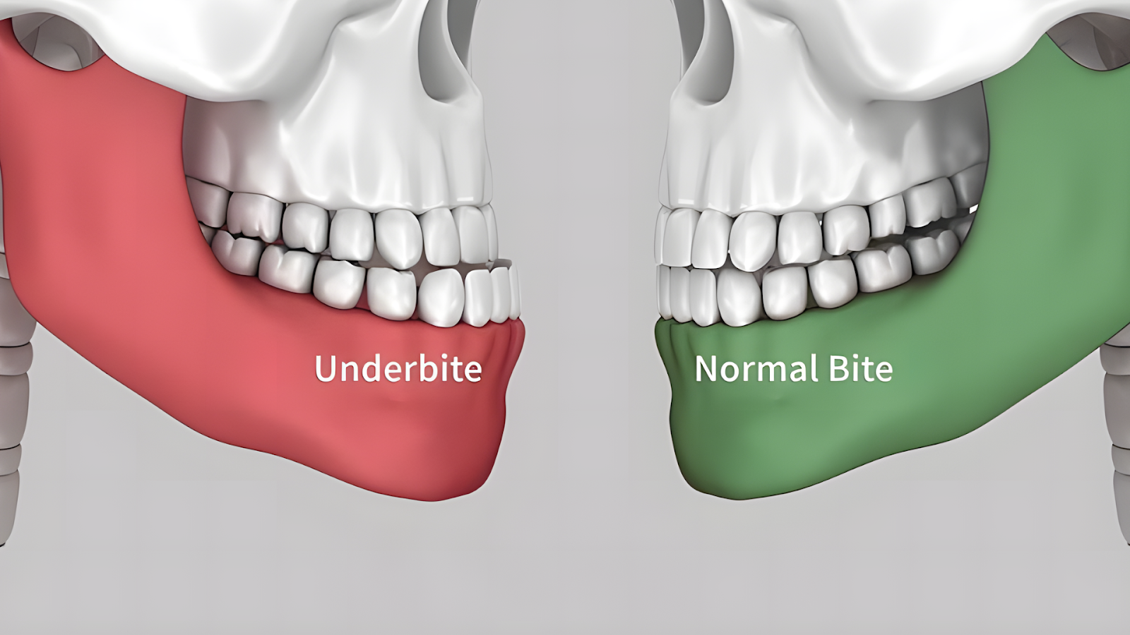 Are braces faster than Invisalign