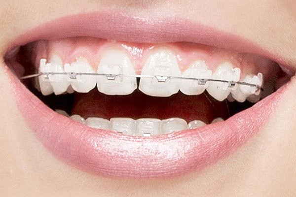 Close-up of clear ceramic brackets on the upper teeth