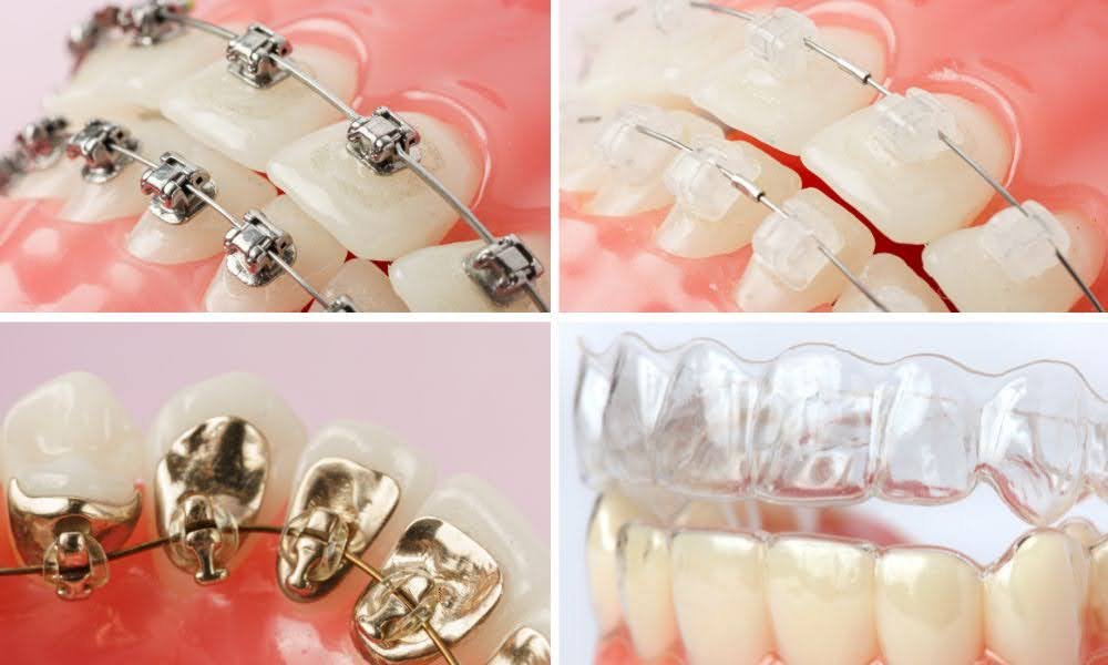Metal, ceramic and gold brackets alongside a clear aligner tray