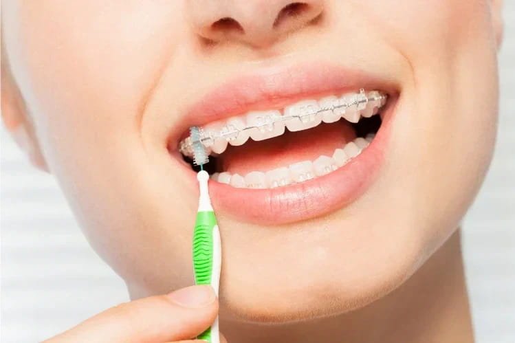 Interdental brush cleaning around brackets and wire