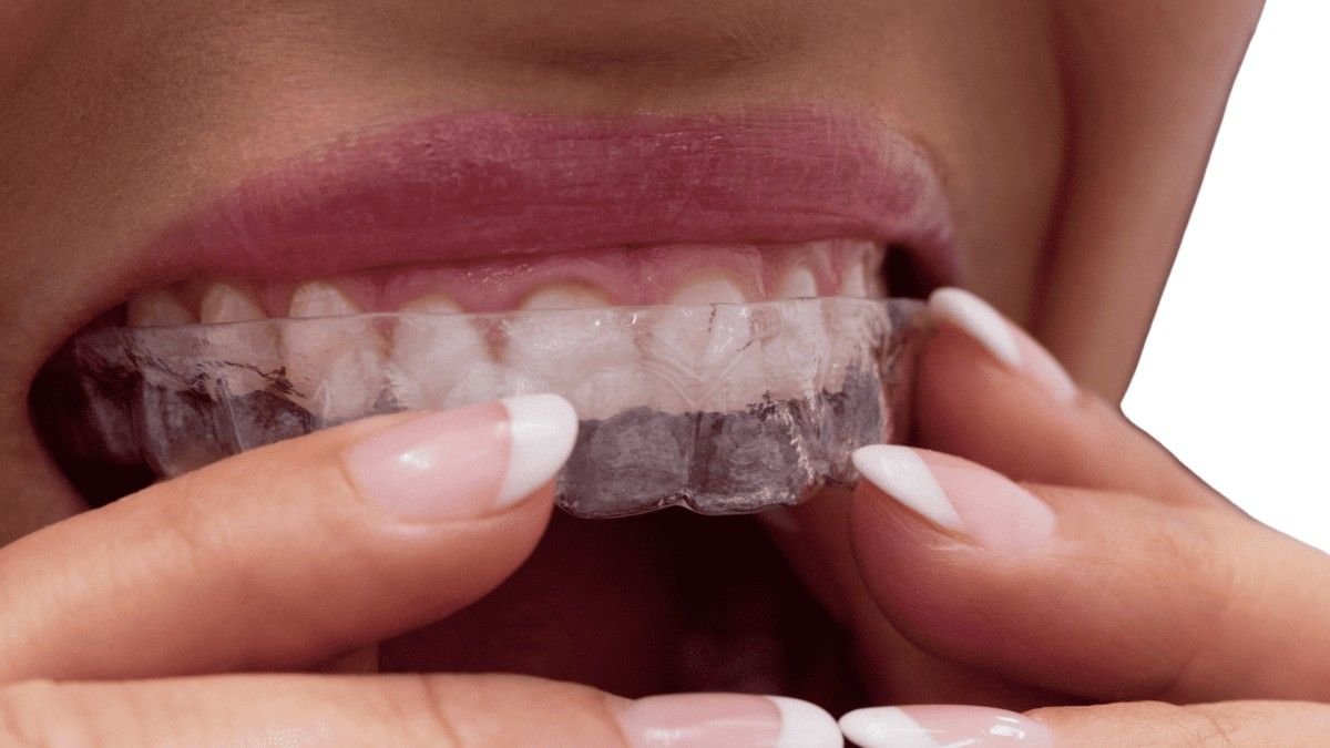 Patient placing a clear Invisalign aligner over her upper teeth